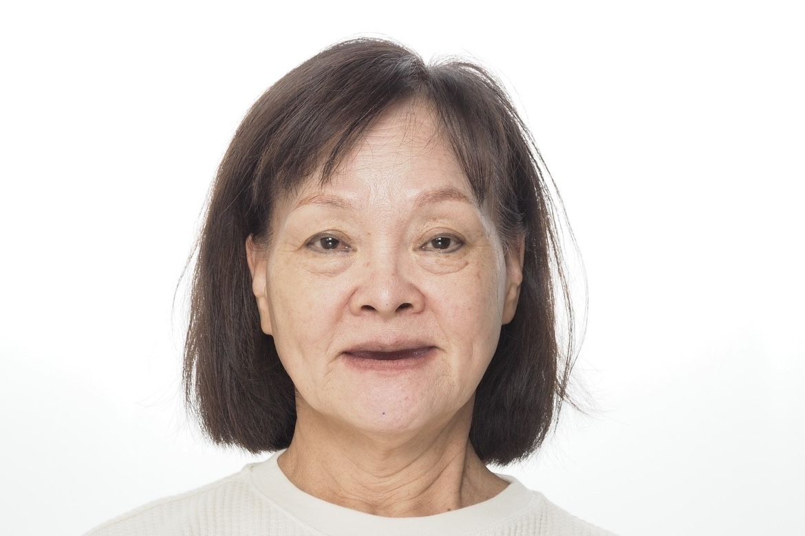 日本BPS活動假牙 配戴體驗分享 【三井牙科集團】最好的母親節禮物~奕妏媽媽分享~