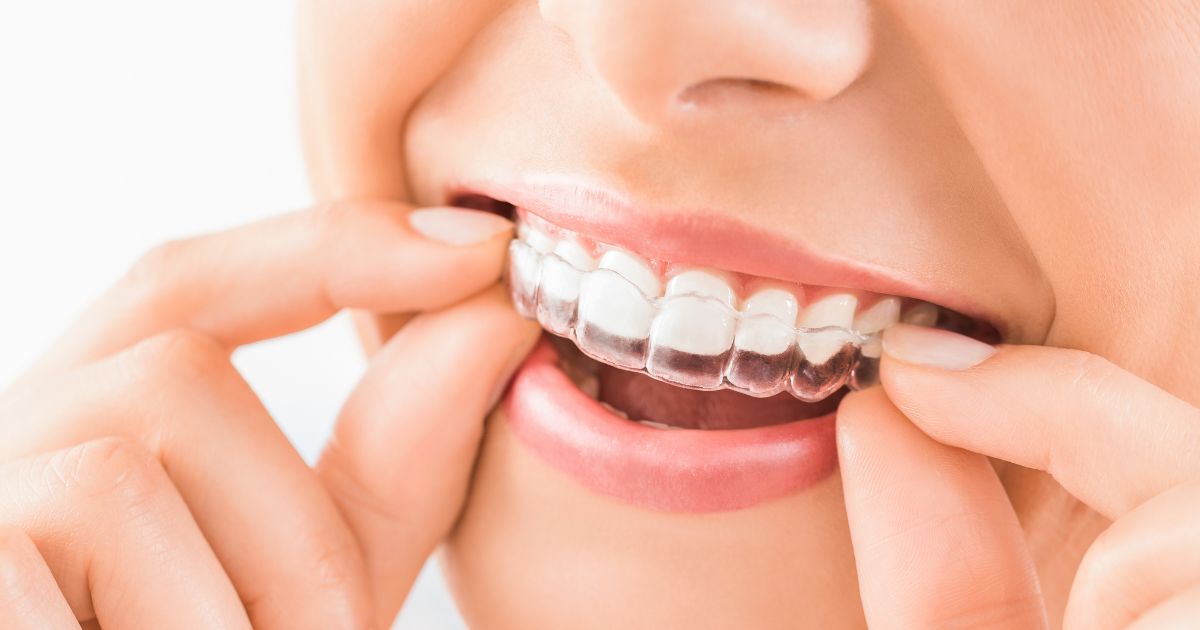 【牙醫師來解答】孩子適合哪種矯正器?固定式v.s.活動式差異大解析!(feat.波音牙醫診所 王子欣醫師) 【牙醫師來解答】孩子適合哪種矯正器?固定式v.s.活動式差異大解析!(feat.波音牙醫診所 王子欣醫師)