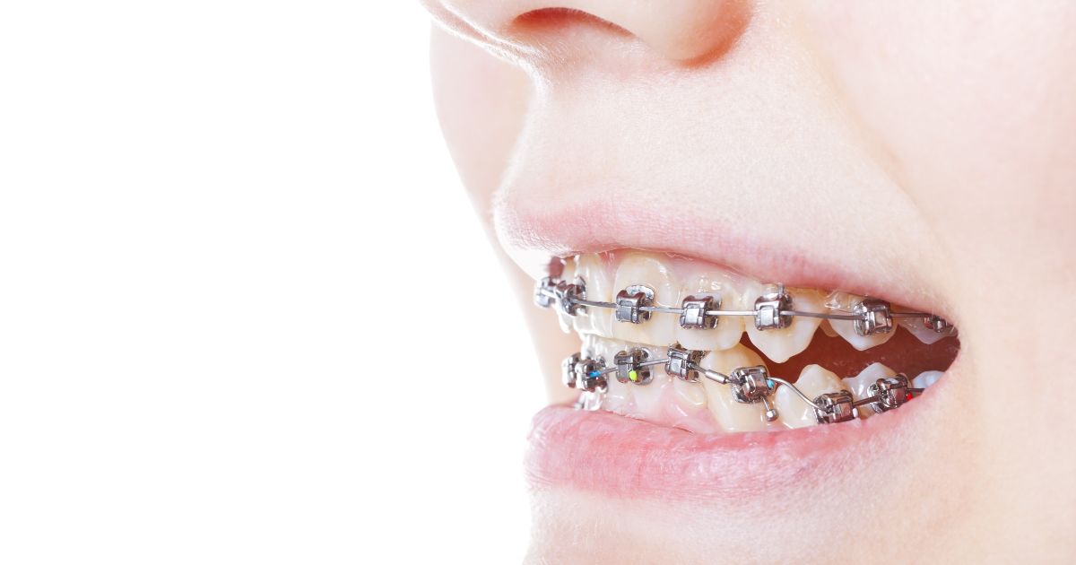 【牙醫師來解答】孩子適合哪種矯正器?固定式v.s.活動式差異大解析!(feat.波音牙醫診所 王子欣醫師) 【牙醫師來解答】孩子適合哪種矯正器?固定式v.s.活動式差異大解析!(feat.波音牙醫診所 王子欣醫師)