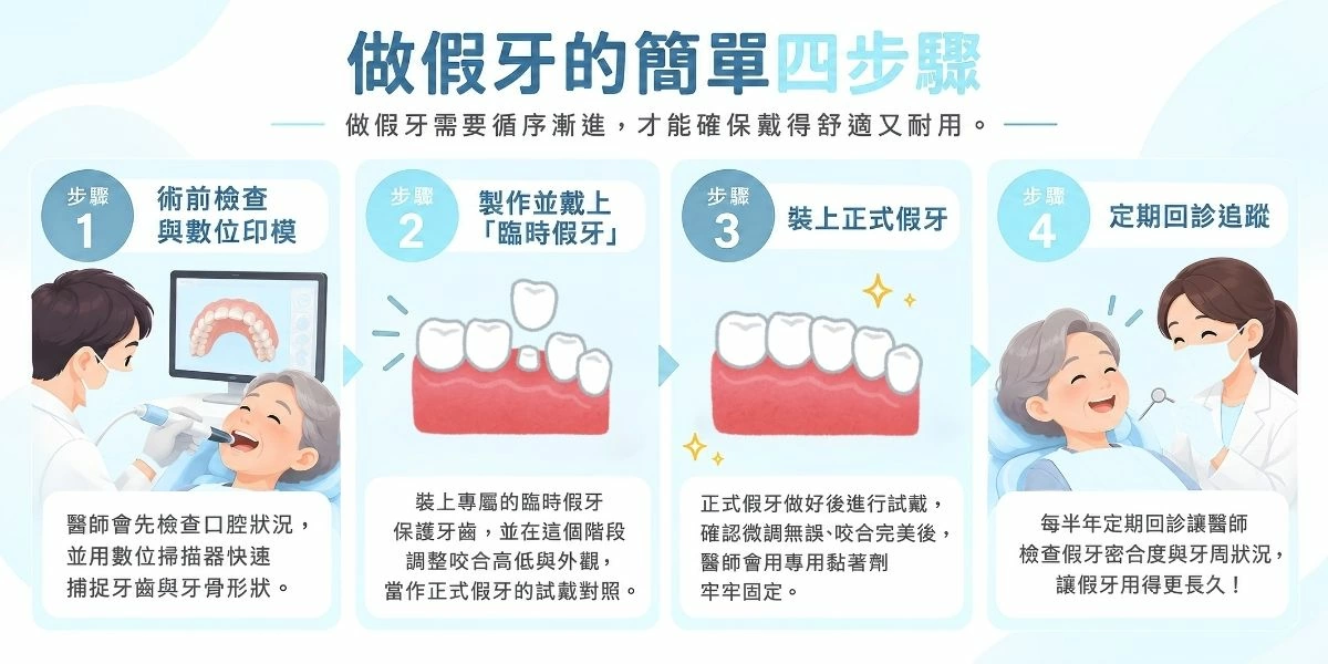 假牙製作四步驟流程示意圖