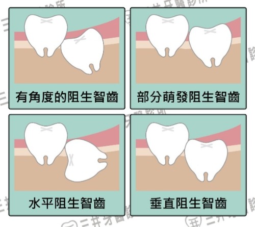 跟智齒說掰掰 跟智齒說掰掰