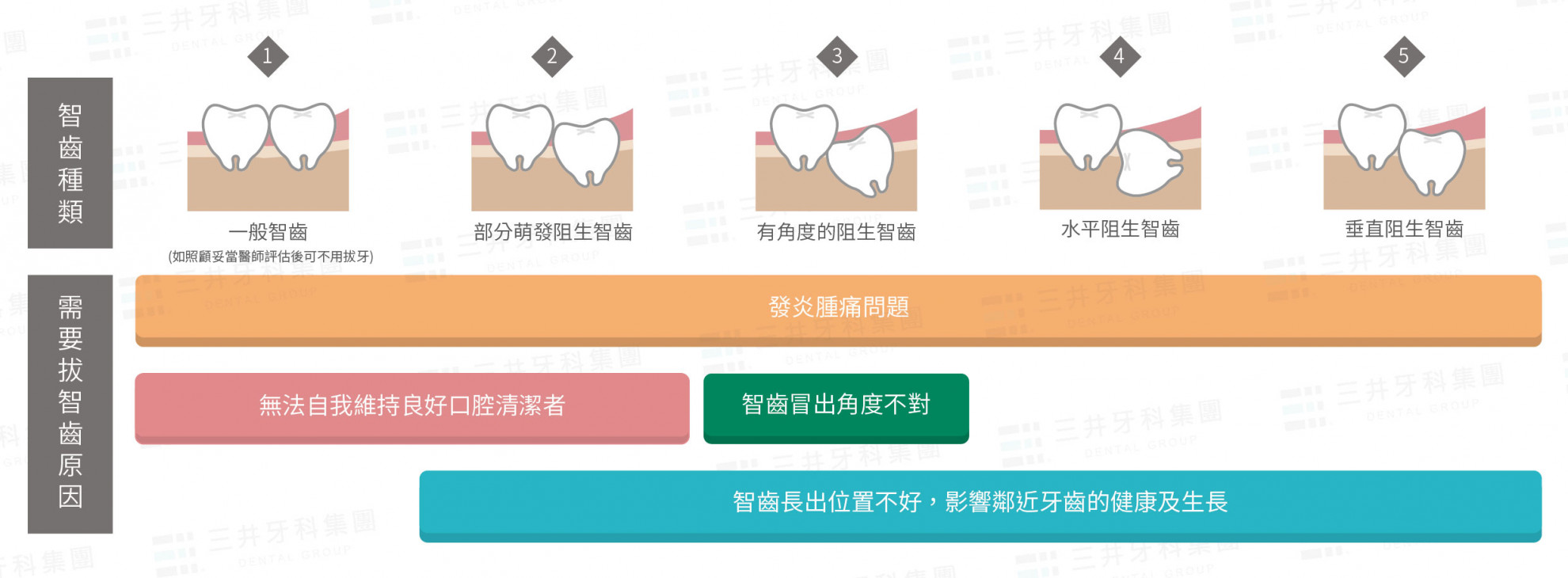 智齒拔不拔 智齒拔不拔