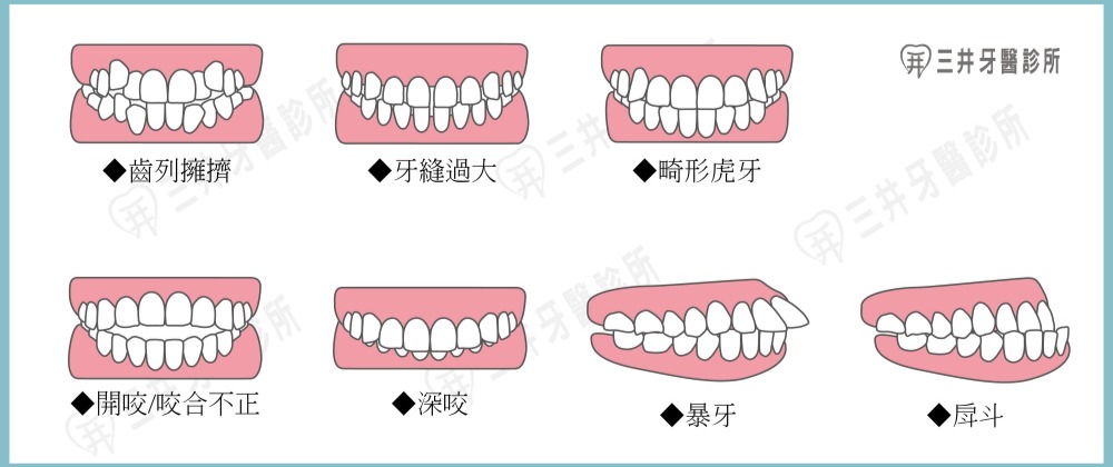 SOV舒服美數位隱形矯正 SOV舒服美數位隱形矯正