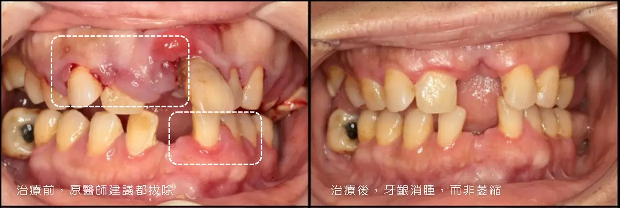 被建議拔牙?你可能還有保留牙齒的機會|牙周微創治療真實案例 被建議拔牙?你可能還有保留牙齒的機會|牙周微創治療真實案例